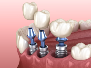 dental implant placements